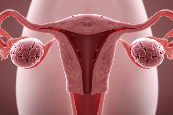 polyendocrine metabolic ovarian syndrome