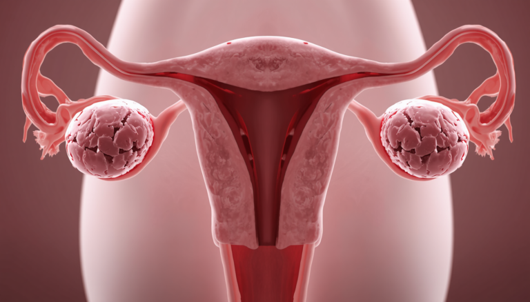 polyendocrine metabolic ovarian syndrome