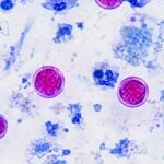Cyclosporiasis