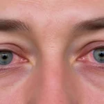 a person with conjunctivitis