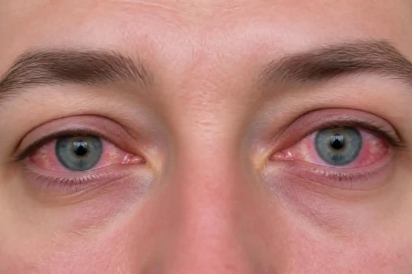 a person with conjunctivitis